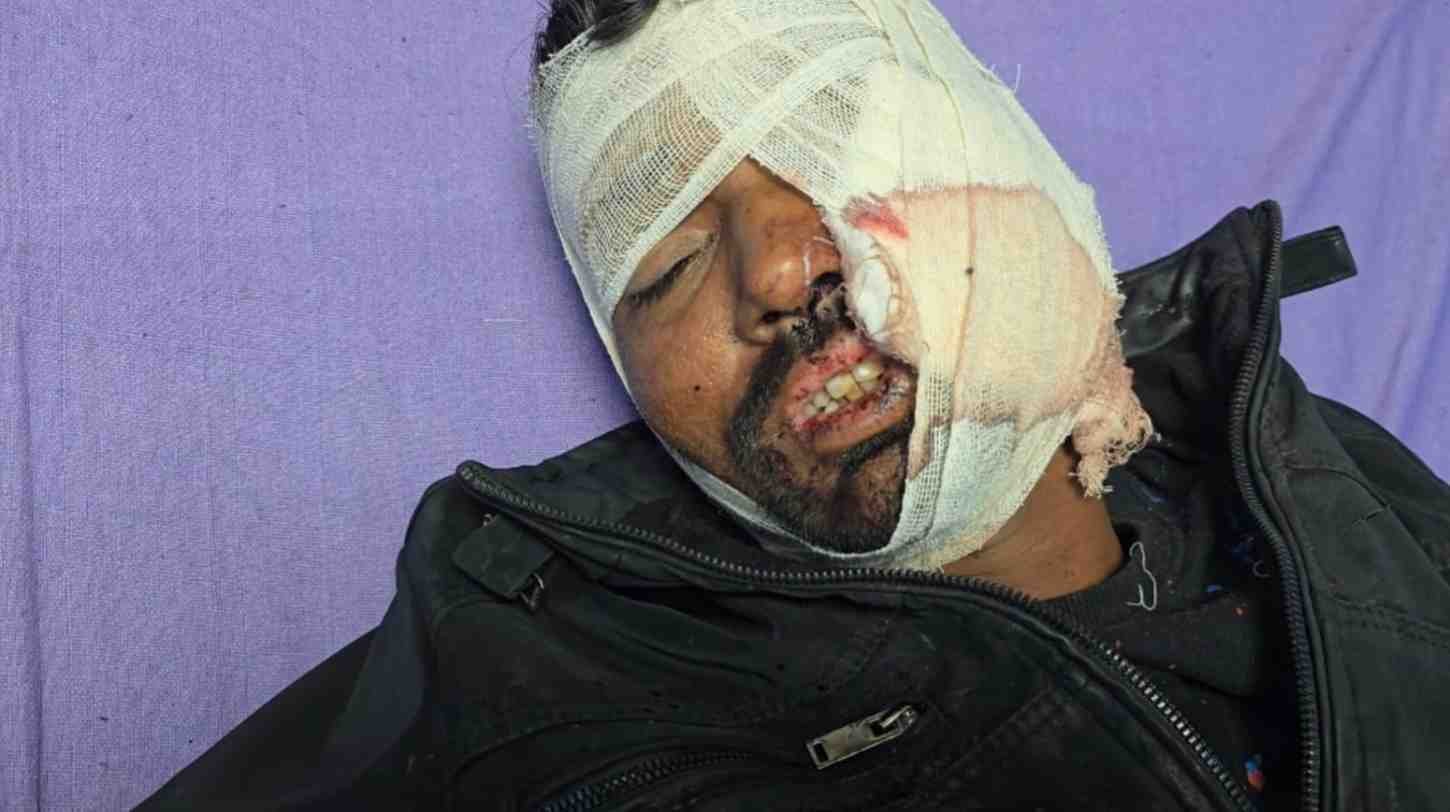 भीमगंज मंडी चाकू हमला लूट मामला: रेलवे स्टेशन के बाहर मजदूर पर जानलेवा हमला, नकदी लूटकर बदमाश फरार